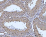 IHC staining of FFPE human endometrioid adenocarcinoma tissue with OCRL-1 antibody. HIER: boil tissue sections in pH8 EDTA for 20 min and allow to cool before testing.