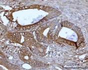 IHC staining of FFPE human colon adenocarcinoma tissue with SSBP1 antibody. HIER: boil tissue sections in pH8 EDTA for 20 min and allow to cool before testing.