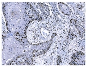 IHC staining of FFPE human esophageal squamous carcinoma tissue with Ki67 antibody. HIER: boil tissue sections in pH8 EDTA for 20 min and allow to cool before testing.