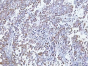 IHC staining of FFPE human lung adenocarcinoma tissue with TMEM87A antibody. HIER: boil tissue sections in pH8 EDTA for 20 min and allow to cool before testing.