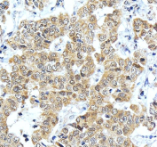 IHC staining of FFPE human liver cancer tissue with ONECUT1 antibody, HRP-secondary and DAB substrate. HIER: boil tissue sections in pH8 EDTA for 20 min and allow to cool before testing.
