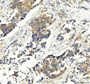 IHC staining of FFPE human breast cancer tissue with 40S ribosomal protein S14 antibody. HIER: boil tissue sections in pH8 EDTA for 20 min and allow to cool before testing.