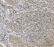 IHC staining of FFPE human rectal cancer tissue with COL4A3 antibody. HIER: boil tissue sections in pH8 EDTA for 20 min and allow to cool before testing.