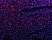 Immunofluorescent staining of FFPE human esophagus squama cancer tissue with Protein phosphatase 1G antibody (red) and DAPI nuclear stain (blue). HIER: steam section in pH8 EDTA buffer for 20 min.