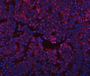 Immunofluorescent staining of FFPE human intestinal cancer tissue with Protein phosphatase 1G antibody (red) and DAPI nuclear stain (blue). HIER: steam section in pH8 EDTA buffer for 20 min.