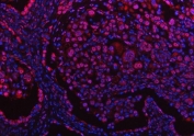 Immunofluorescent staining of FFPE human lung cancer tissue with Protein phosphatase 1G antibody (red) and DAPI nuclear stain (blue). HIER: steam section in pH8 EDTA buffer for 20 min.