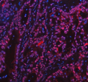 Immunofluorescent staining of FFPE human pancreas squama cancer tissue with Protein phosphatase 1G antibody (red) and DAPI nuclear stain (blue). HIER: steam section in pH8 EDTA buffer for 20 min.
