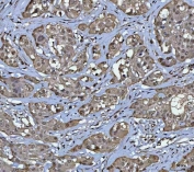 IHC staining of FFPE human lymphoma tissue with Protein phosphatase 1G antibody. HIER: boil tissue sections in pH8 EDTA for 20 min and allow to cool before testing.