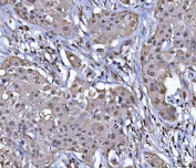 IHC staining of FFPE human lymphoma tissue with Protein phosphatase 1G antibody. HIER: boil tissue sections in pH8 EDTA for 20 min and allow to cool before testing.