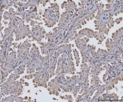 IHC staining of FFPE human lung cancer tissue with Protein phosphatase 1G antibody. HIER: boil tissue sections in pH8 EDTA for 20 min and allow to cool before testing.