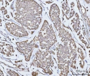 IHC staining of FFPE human breast cancer tissue with Protein phosphatase 1G antibody. HIER: boil tissue sections in pH8 EDTA for 20 min and allow to cool before testing.