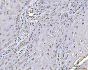 IHC staining of FFPE human skin squamous carcinoma tissue with Protein phosphatase 1G antibody. HIER: boil tissue sections in pH8 EDTA for 20 min and allow to cool before testing.