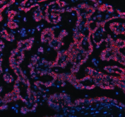 Immunofluorescent staining of FFPE human lung cancer tissue with OTT1 antibody (red) and DAPI nuclear stain (blue). HIER: steam section in pH8 EDTA buffer for 20 min.