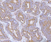 IHC staining of FFPE human rectum adenocarcinoma tissue with HRPAP20 antibody. HIER: boil tissue sections in pH8 EDTA for 20 min and allow to cool before testing.