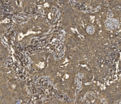 IHC staining of FFPE human lung cancer tissue with Eukaryotic translation initiation factor 5 antibody. HIER: boil tissue sections in pH8 EDTA for 20 min and allow to cool before testing.
