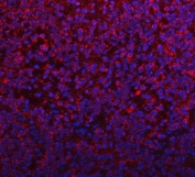 Immunofluorescent staining of FFPE human glioma tissue with PYCR1 antibody (red) and DAPI nuclear stain (blue). HIER: steam section in pH8 EDTA buffer for 20 min.