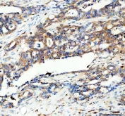 IHC staining of FFPE human pancreas cancer tissue with PYGL antibody. HIER: boil tissue sections in pH8 EDTA for 20 min and allow to cool before testing.