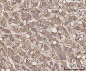 IHC staining of FFPE human liver cancer tissue with C-C motif chemokine 23 antibody. HIER: boil tissue sections in pH8 EDTA for 20 min and allow to cool before testing.
