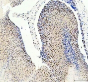 IHC staining of FFPE human skin cancer tissue with PRPF4 antibody. HIER: boil tissue sections in pH8 EDTA for 20 min and allow to cool before testing.