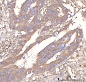 IHC staining of FFPE human rectum adenocarcinoma tissue with Neuralized-like protein 4 antibody. HIER: boil tissue sections in pH8 EDTA for 20 min and allow to cool before testing.