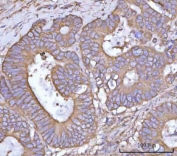 IHC staining of FFPE human rectum adenocarcinoma tissue with NANP antibody. HIER: boil tissue sections in pH8 EDTA for 20 min and allow to cool before testing.