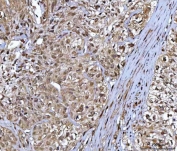 IHC staining of FFPE human bladder urothelial carcinoma tissue with NR5A2 antibody. HIER: boil tissue sections in pH8 EDTA for 20 min and allow to cool before testing.
