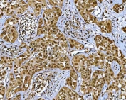 IHC staining of FFPE human parotid acinar cell carcinoma tissue with NR5A2 antibody. HIER: boil tissue sections in pH8 EDTA for 20 min and allow to cool before testing.
