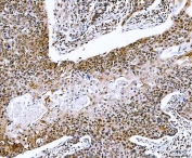 IHC staining of FFPE human esophageal squamous carcinoma tissue with NVL antibody. HIER: boil tissue sections in pH8 EDTA for 20 min and allow to cool before testing.