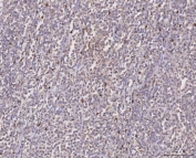 IHC staining of FFPE human arge B-cell lymphoma tissue with MGAT2 antibody. HIER: boil tissue sections in pH8 EDTA for 20 min and allow to cool before testing.