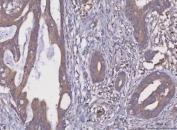 IHC staining of FFPE human rectal cancer tissue with MGAT2 antibody. HIER: boil tissue sections in pH8 EDTA for 20 min and allow to cool before testing.