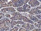 IHC staining of FFPE human liver cancer tissue with MOCS2 antibody. HIER: boil tissue sections in pH8 EDTA for 20 min and allow to cool before testing.