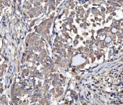 IHC staining of FFPE human lung cancer tissue with MOCS2 antibody. HIER: boil tissue sections in pH8 EDTA for 20 min and allow to cool before testing.
