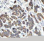 IHC staining of FFPE human breast cancer tissue with Keratin 19 antibody. HIER: boil tissue sections in pH8 EDTA for 20 min and allow to cool before testing.