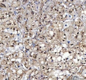 IHC staining of FFPE human adrenocortical adenoma tissue with c-Kit antibody. HIER: boil tissue sections in pH8 EDTA for 20 min and allow to cool before testing.