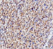 IHC staining of FFPE human liver cancer tissue with NUDT6 antibody. HIER: boil tissue sections in pH8 EDTA for 20 min and allow to cool before testing.
