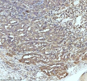 IHC staining of FFPE human ovarian cancer tissue with GCLM antibody. HIER: boil tissue sections in pH8 EDTA for 20 min and allow to cool before testing.