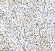 IHC staining of FFPE human clear cell renal cell carcinoma tissue with GCLM antibody. HIER: boil tissue sections in pH8 EDTA for 20 min and allow to cool before testing.