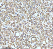 IHC staining of FFPE human liver cancer tissue with GCLM antibody. HIER: boil tissue sections in pH8 EDTA for 20 min and allow to cool before testing.