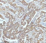 IHC staining of FFPE human rectum adenocarcinoma tissue with GCLM antibody. HIER: boil tissue sections in pH8 EDTA for 20 min and allow to cool before testing.