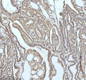 IHC staining of FFPE human thyroid papillary carcinoma tissue with GCLM antibody. HIER: boil tissue sections in pH8 EDTA for 20 min and allow to cool before testing.