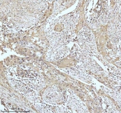IHC staining of FFPE human urothelial carcinoma tissue with GCLM antibody. HIER: boil tissue sections in pH8 EDTA for 20 min and allow to cool before testing.
