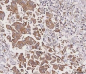 IHC staining of FFPE human liver cancer tissue with MGAT3 antibody. HIER: boil tissue sections in pH8 EDTA for 20 min and allow to cool before testing.