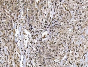 IHC staining of FFPE human bladder urothelial carcinoma tissue with MED26 antibody. HIER: boil tissue sections in pH8 EDTA for 20 min and allow to cool before testing.