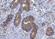 IHC staining of FFPE human colorectal adenocarcinoma tissue with MGME1 antibody. HIER: boil tissue sections in pH8 EDTA for 20 min and allow to cool before testing.