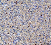 IHC staining of FFPE human glioma tissue with MGAT4B antibody. HIER: boil tissue sections in pH8 EDTA for 20 min and allow to cool before testing.