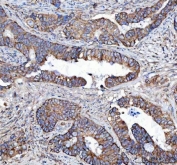 IHC staining of FFPE human colorectal adenocarcinoma tissue with MLEC antibody. HIER: boil tissue sections in pH8 EDTA for 20 min and allow to cool before testing.