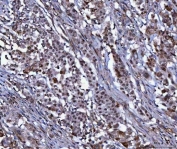IHC staining of FFPE human lung cancer tissue with CML66 antibody. HIER: boil tissue sections in pH8 EDTA for 20 min and allow to cool before testing.