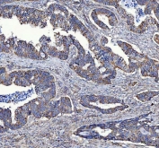 IHC staining of FFPE human colorectal adenocarcinoma tissue with MTCL1 antibody. HIER: boil tissue sections in pH8 EDTA for 20 min and allow to cool before testing.