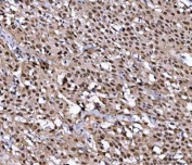 IHC staining of FFPE human bladder urothelial carcinoma tissue with NUP37 antibody. HIER: boil tissue sections in pH8 EDTA for 20 min and allow to cool before testing.