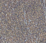 IHC staining of FFPE human large B-cell lymphoma tissue with NEEP21 antibody. HIER: boil tissue sections in pH8 EDTA for 20 min and allow to cool before testing.